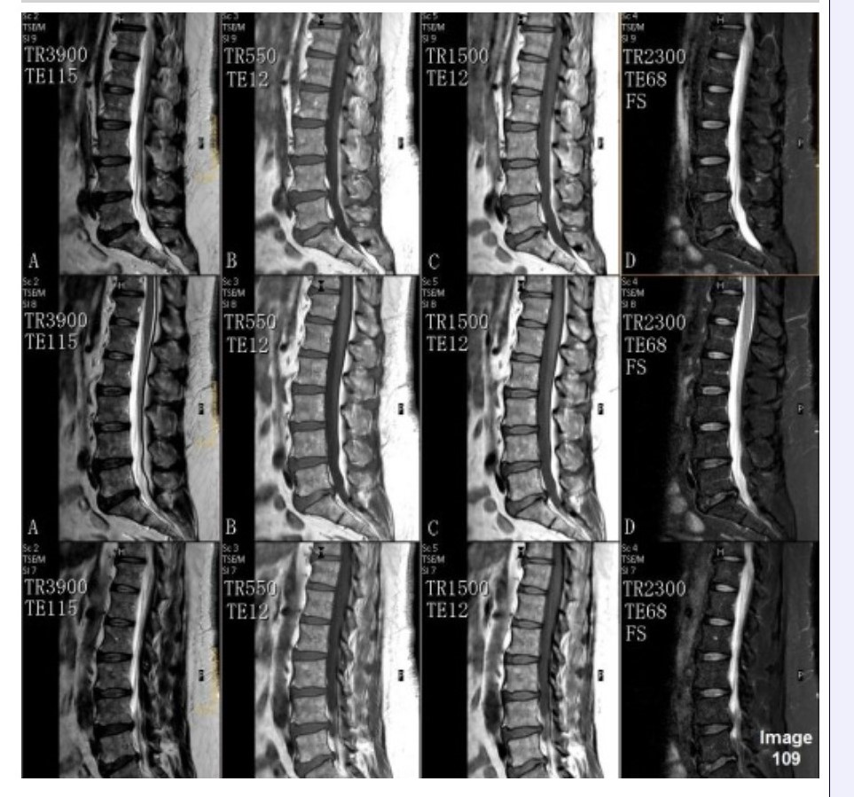 <p><span>Column D in Image 109 corresponds to which MRI pulse sequence?</span></p><p><span>&nbsp;A. Proton density</span></p><p><span>&nbsp;B. T1 weighted</span></p><p><span>&nbsp;C. T2 weighted</span></p><p><span>&nbsp;D. T2 FLAIR</span></p><p><span>&nbsp;E. T2 weighted with fat suppression</span></p>