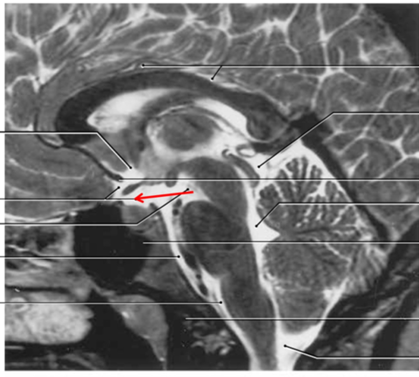<p>inferior and anterior to optic chiasm</p><p>-enlaaragement of subararchnoid space</p>