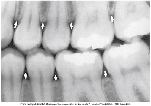 <p><span>Radiographically, the cortical plate cannot be seen because it is only on the buccal and lingual sides of the socket. A radiograph will show the cribriform plate, the spongy bone and the crest of bone that joins the two sockets (the interproximal alveolar crest of bone). The contours of this area are a good indicator of periodontal health.</span></p>