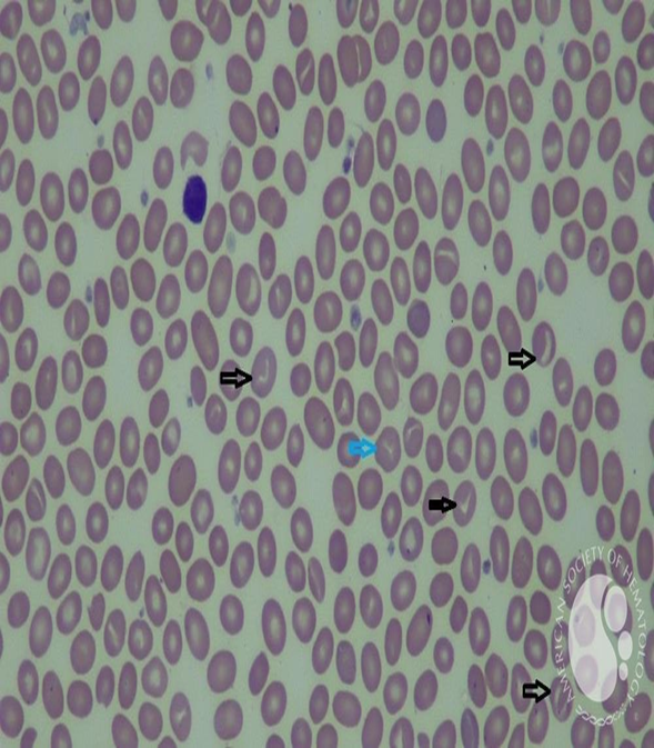 <p><span>Ovalocyte</span></p>