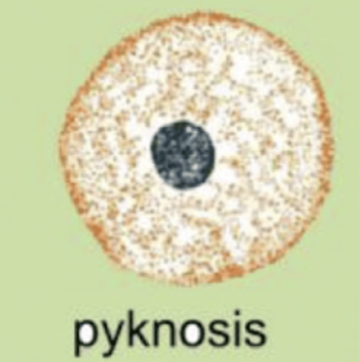 <p>the condensation of chromatin in the nucleus of a cell due to cell death. the nucleus appears shrunken, dark, homogenous, and round</p>