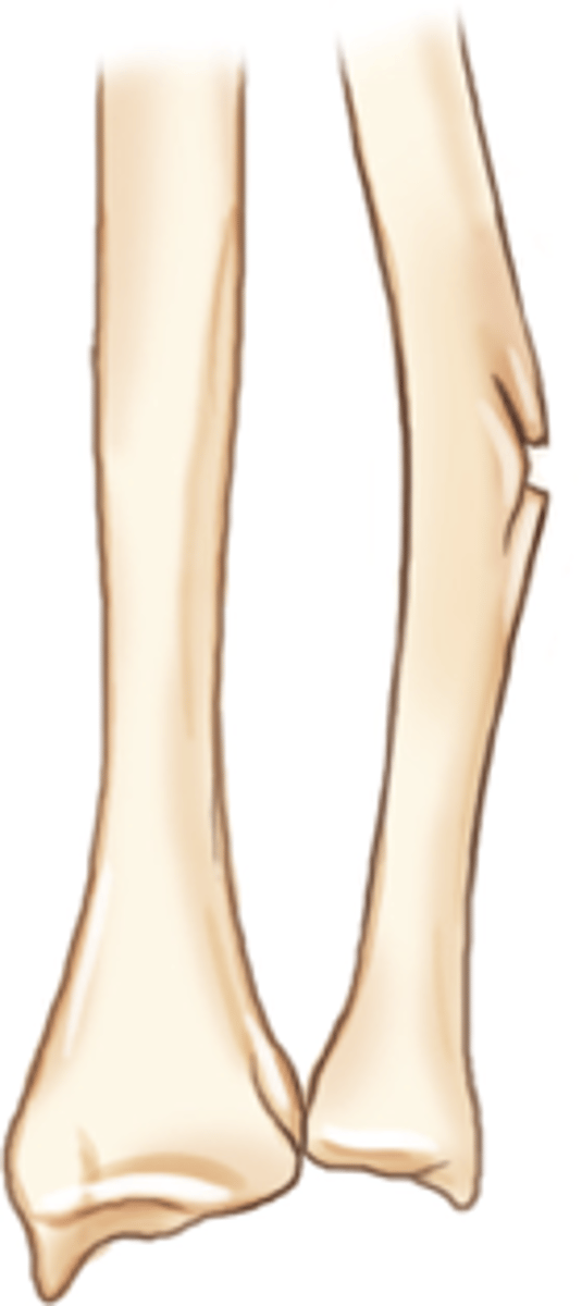 <p>Fracture does not traverse through entire bone</p><p>Examples:</p><p>- Torus fracture</p><p>- Greenstick fracture (imaged)</p><p>- Plastic fracture</p>