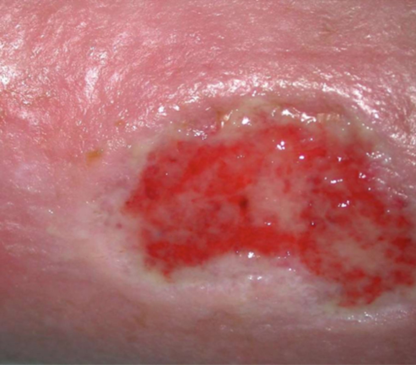 <p>¿lesión?</p><p>¿primaria o secundaria?</p>