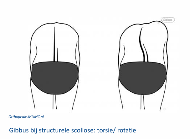 <ul><li><p>functionele= door bv beenlengte verschil, zodra dat is opgelost verdwijnt de scoliose.</p></li><li><p>structurele= vergroeiing en kan een torsie of gibbus te zien zijn</p></li></ul><p></p>
