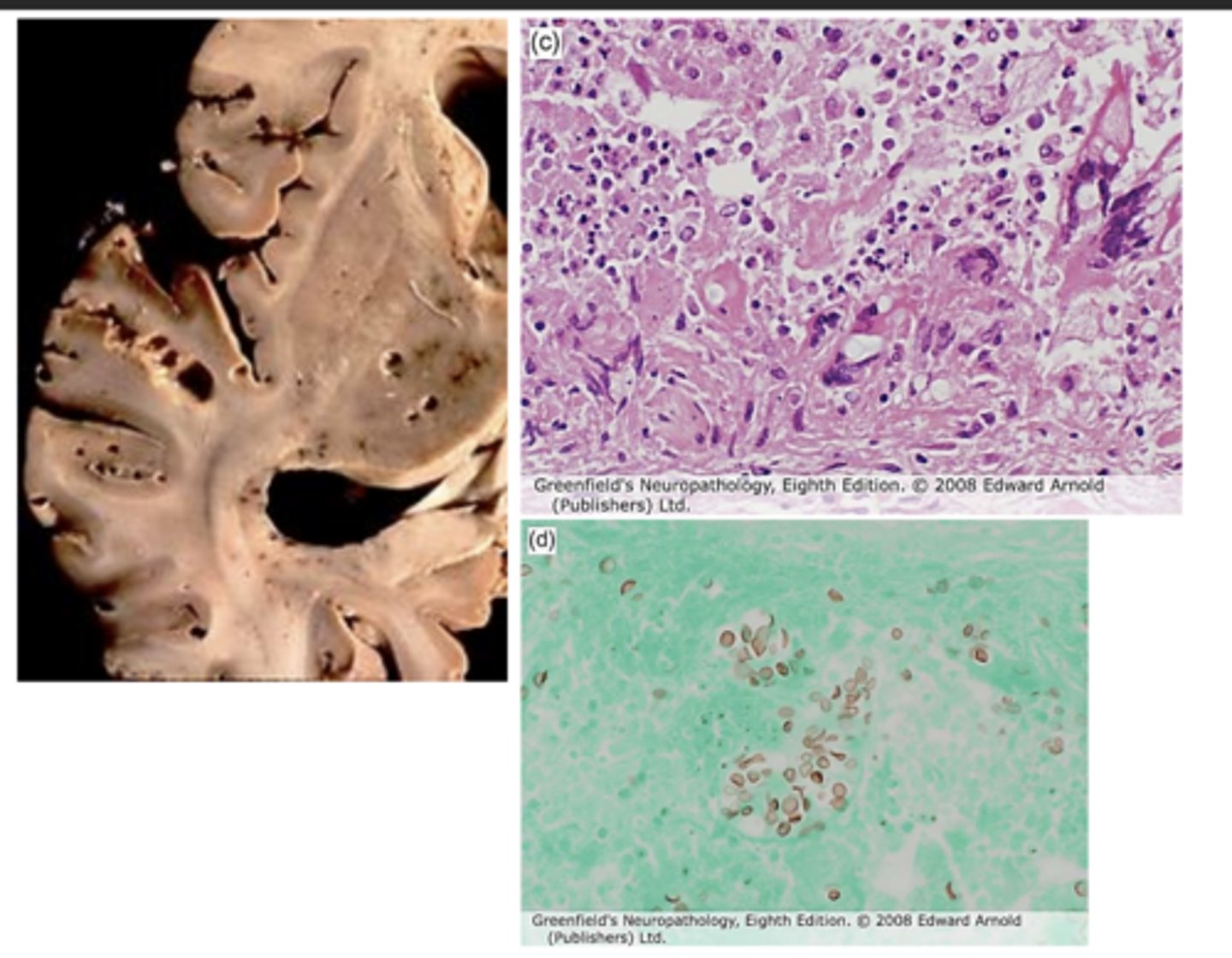 <p>Cryptococcus meningitis:</p>