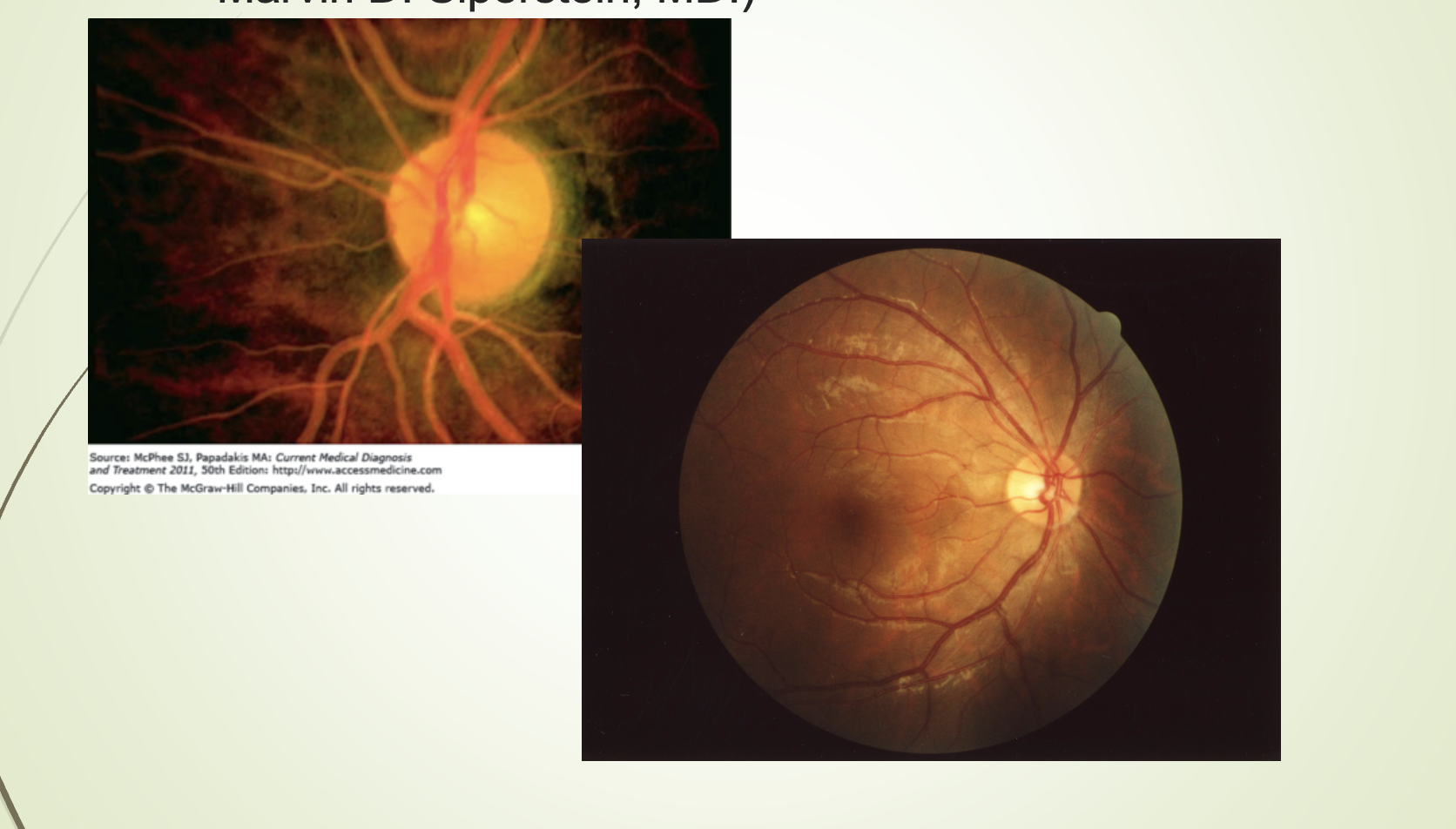 <ul><li><p><span>Lipemia retinalis.</span></p></li><li><p><span>Caused by extremely high triglycerides (> 2000 mg/dL).</span></p></li><li><p><span>Retinal vessels appear cream‑colored.</span></p></li></ul><p></p>