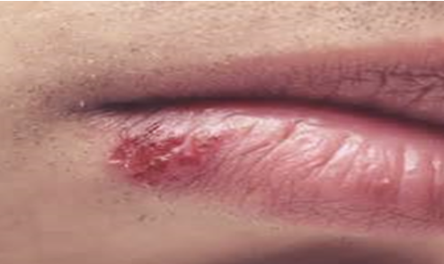 <p>Een type 1 afwijking die voornamelijk bij de mond voorkomt. De diagnose zien we meestal aan de hand van het klinisch beeld. Deze afwijking wordt verspreid door contact, meestal al op jonge leeftijd. Je krijgt dan maar 1 keer een infectie van (primaire infectie) en daarna kan dit zich terugkerend uiten.</p>