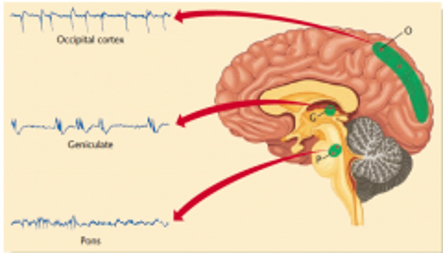 <p>pontine-geniculate-occipital waves; occur before rem, linked to dreaming.</p>