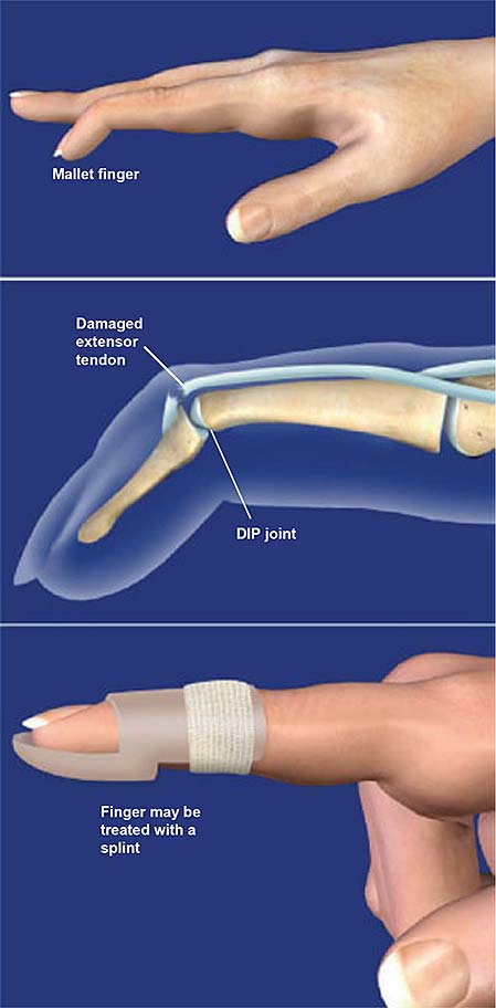 <ul><li><p><strong><mark data-color="blue" style="background-color: blue; color: inherit">mallet finger deformity</mark></strong></p></li><li><p><strong><mark data-color="purple" style="background-color: purple; color: inherit">0-8wks:</mark></strong> DIP extension orthosis</p></li><li><p><strong><mark data-color="purple" style="background-color: purple; color: inherit">6-8wks:</mark></strong> gentle AROM</p></li><li><p>orthotics worn at night and btw exercises</p></li></ul><p></p>