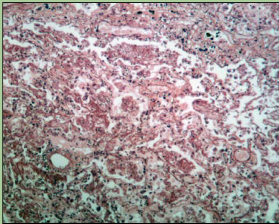 What disorder is this?