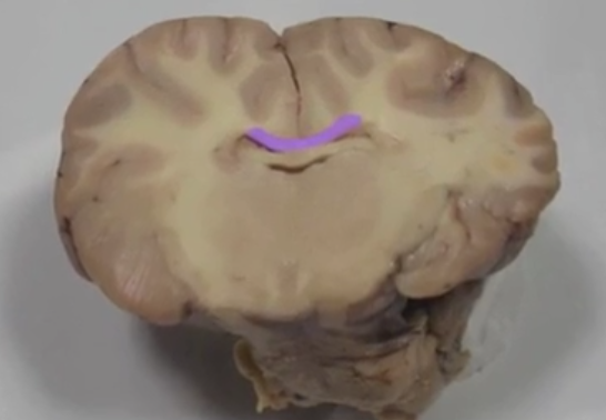 <p>Corpus callosum </p>