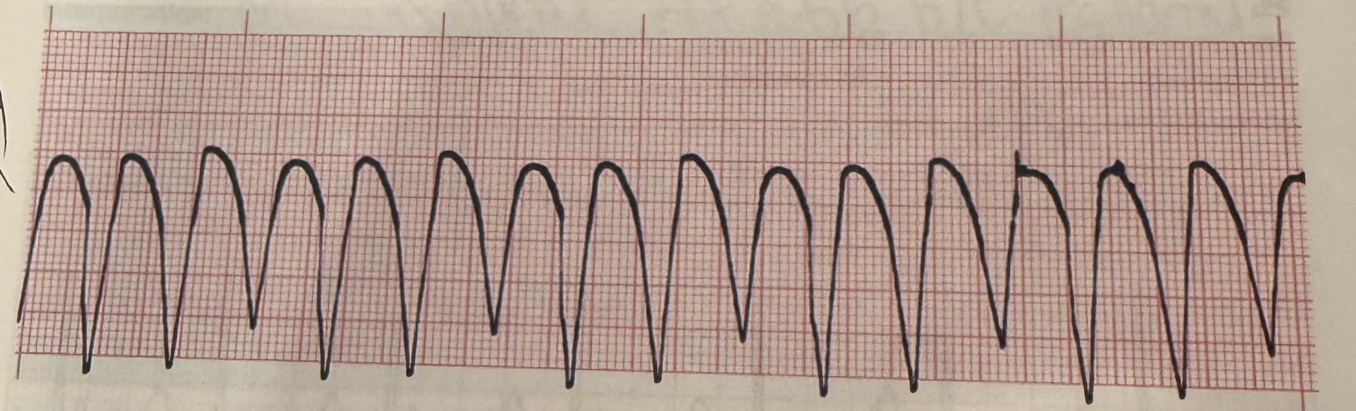 <p>v tach </p>