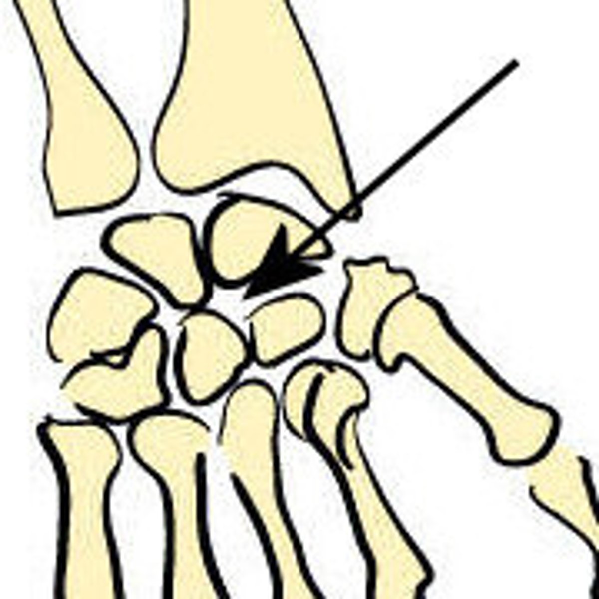 <p>type of joint in which the articular surfaces are only slightly convex and concave. Slight nonaxial or multiaxial</p>
