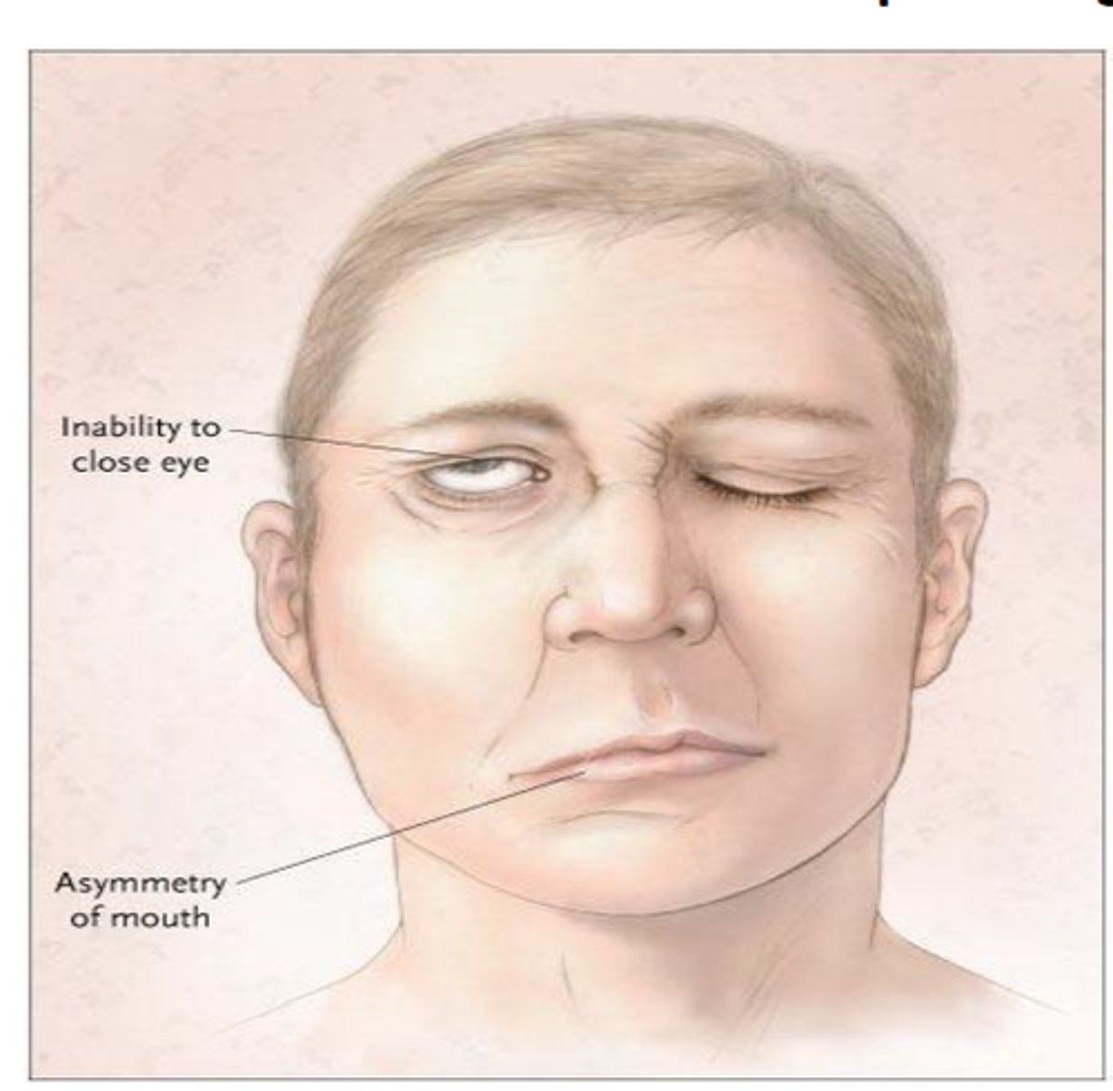 <p>Facial paralysis caused by irritation of cranial nerve VII; cause unknown, most patients recover; inflammation treated with steroids; eye irritation treated with eye ointment and sunglasses; in some cases surgery is necessary</p>