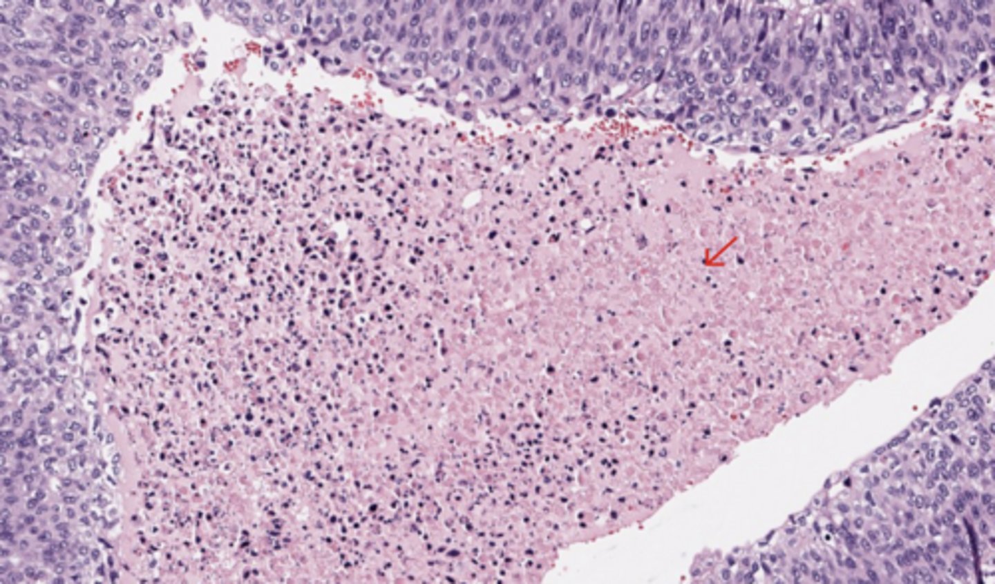 <p>Urothelial tract</p>