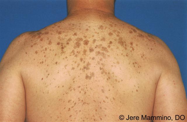 <p>“liver spot” - usually benign, flat, brown macules (flat discoloration) from sun exposure</p>
