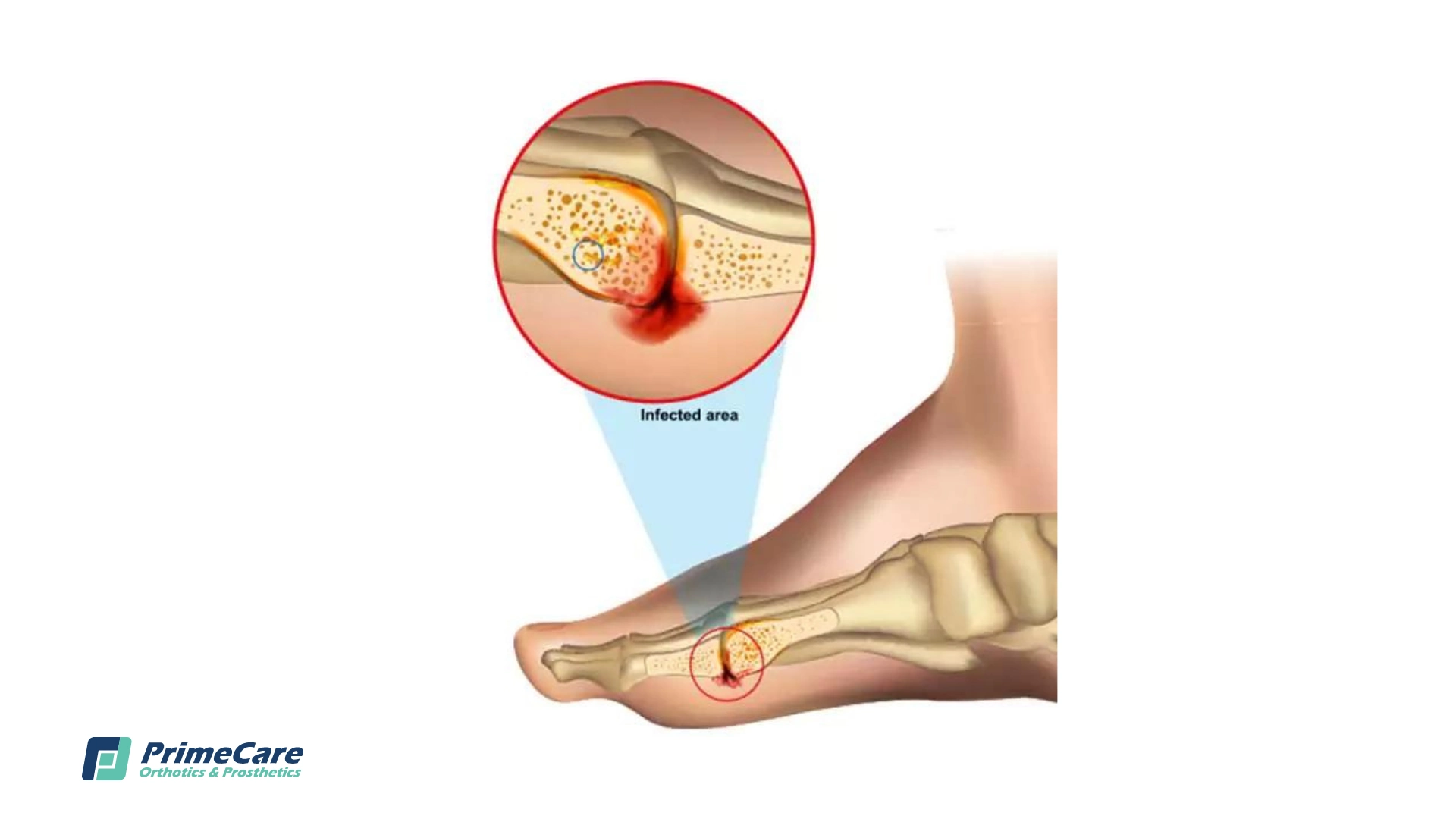 <p>Abscess on bone</p><ul><li><p>Etiol: Bacterial (staph) or Fungal (open wounds, bone fractures)</p></li><li><p>Dx: MRI shows abscess</p></li><li><p>S/S: Edema (swelling from fluid), Erythema (redness), warmth</p></li><li><p>Tx: Antibiotics (bacterial, Antifungals (Fungal), Surgical drainage or Debridement (remove dead tissue), Bone Graft, Amputation</p></li></ul><p></p>