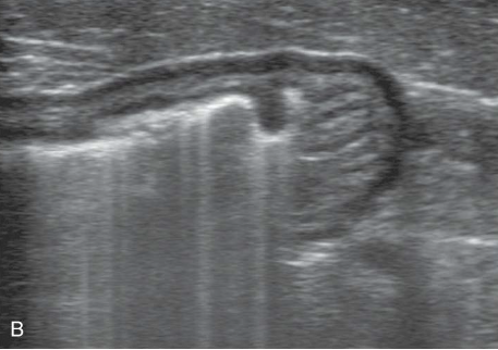 <ul><li><p>highly reflective surfaces </p></li><li><p>sound waves bounce back and forth - produce echoic lines at regular intervals</p></li><li><p>commonly caused by gas or free air</p></li></ul><p></p>
