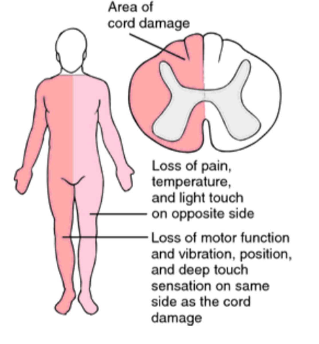 <p>This image depicts the damage associated with which Incomplete SCI Syndrome?</p>