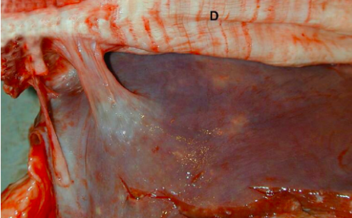 <p>Lever fra kvæg og diaphragma (d), hvad er den patoanatomiske diagnose?</p>