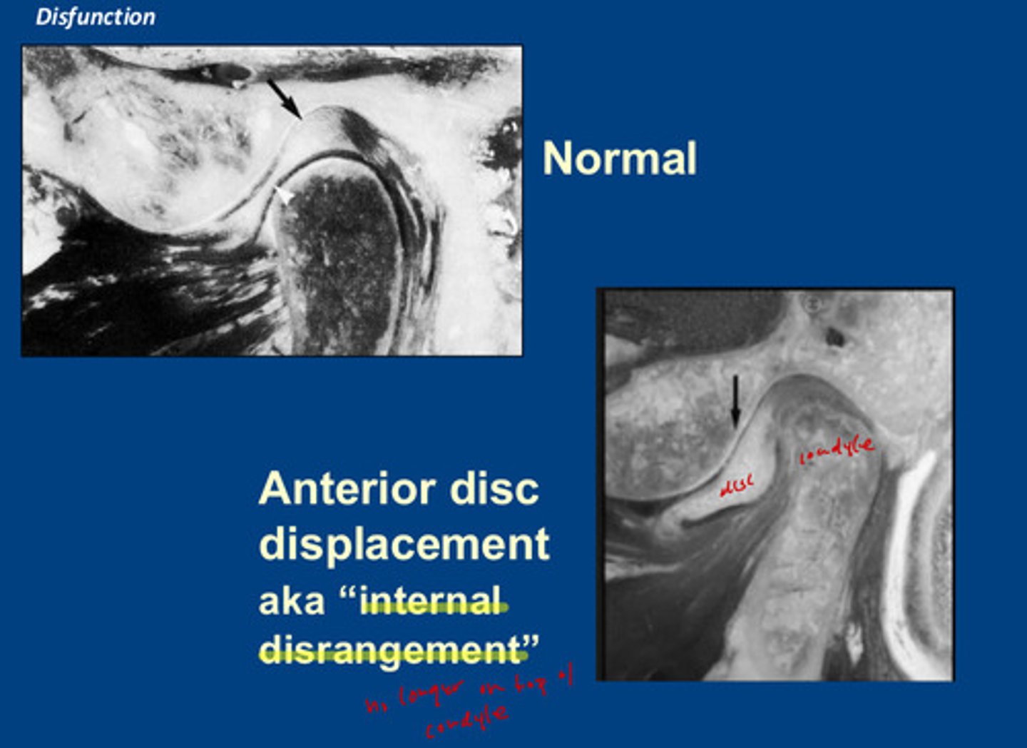 <p>the disc is no longer on top of the condyle! it is displaced anteriorly in relation to the condyle</p>