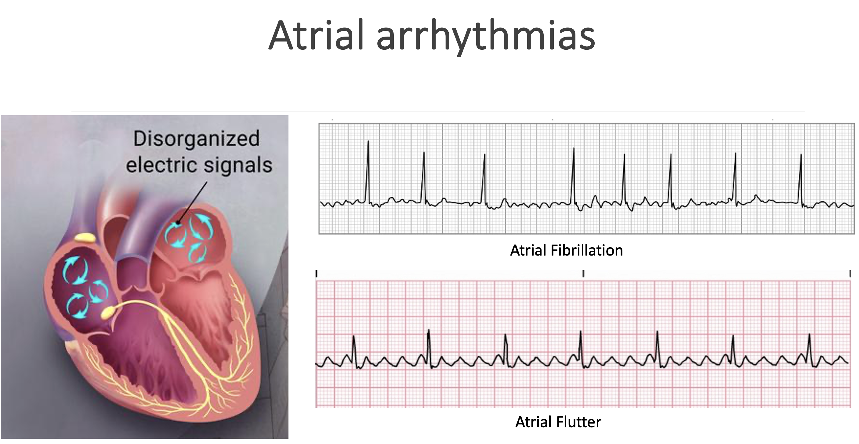 <p>Atrial arrhythmias </p>