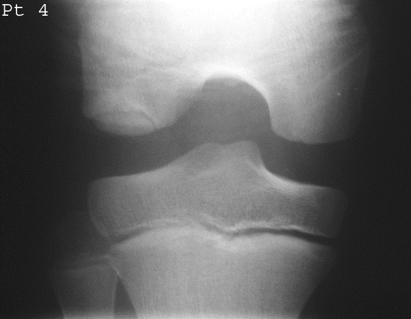 <p>What is Osteochondritis Dissecans?</p>