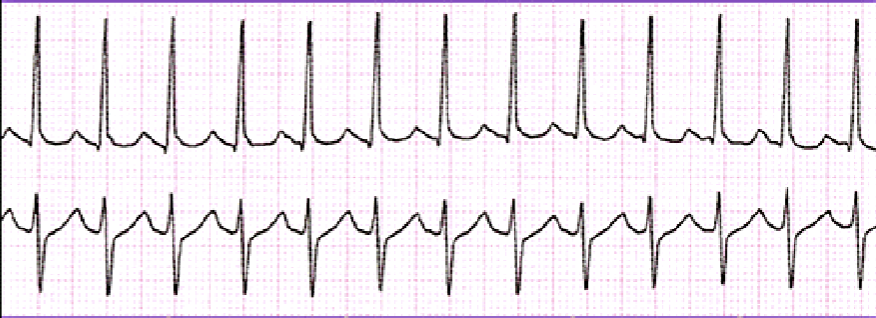 <p>Rate: 100-280 BPM<br>Rhythm: Regular<br>P-Wave: May not see due to fast rate<br>PR: Varies<br>QRS: 0.06-0.10</p>