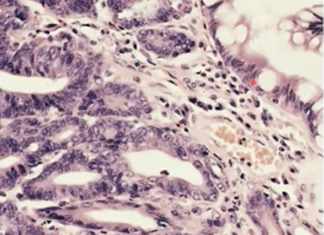 Dysplasia occurs, cytonucleur atypia = large nuclei, irregular shape and coarse chromatin pattern. 