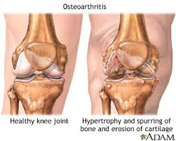 <ul><li><p>AKA arthritis </p></li><li><p>wearing down or articular cartilage </p></li><li><p>can be result of aging </p></li></ul><p></p>