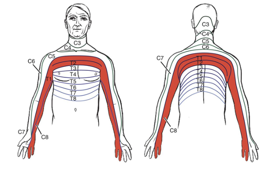 <p>Tumor located in apex of lungs</p><ul><li><p>symptom presentation can mimic TOS </p></li><li><p>C8, T1, T2 dermatomes</p></li><li><p>lower trunks of brachial plexus</p></li><li><p>C8-T1 nerve roots</p></li><li><p>initially sharp posterior shoulder pain</p></li><li><p>pain in axilla and sub scapular regions </p></li></ul><p></p>