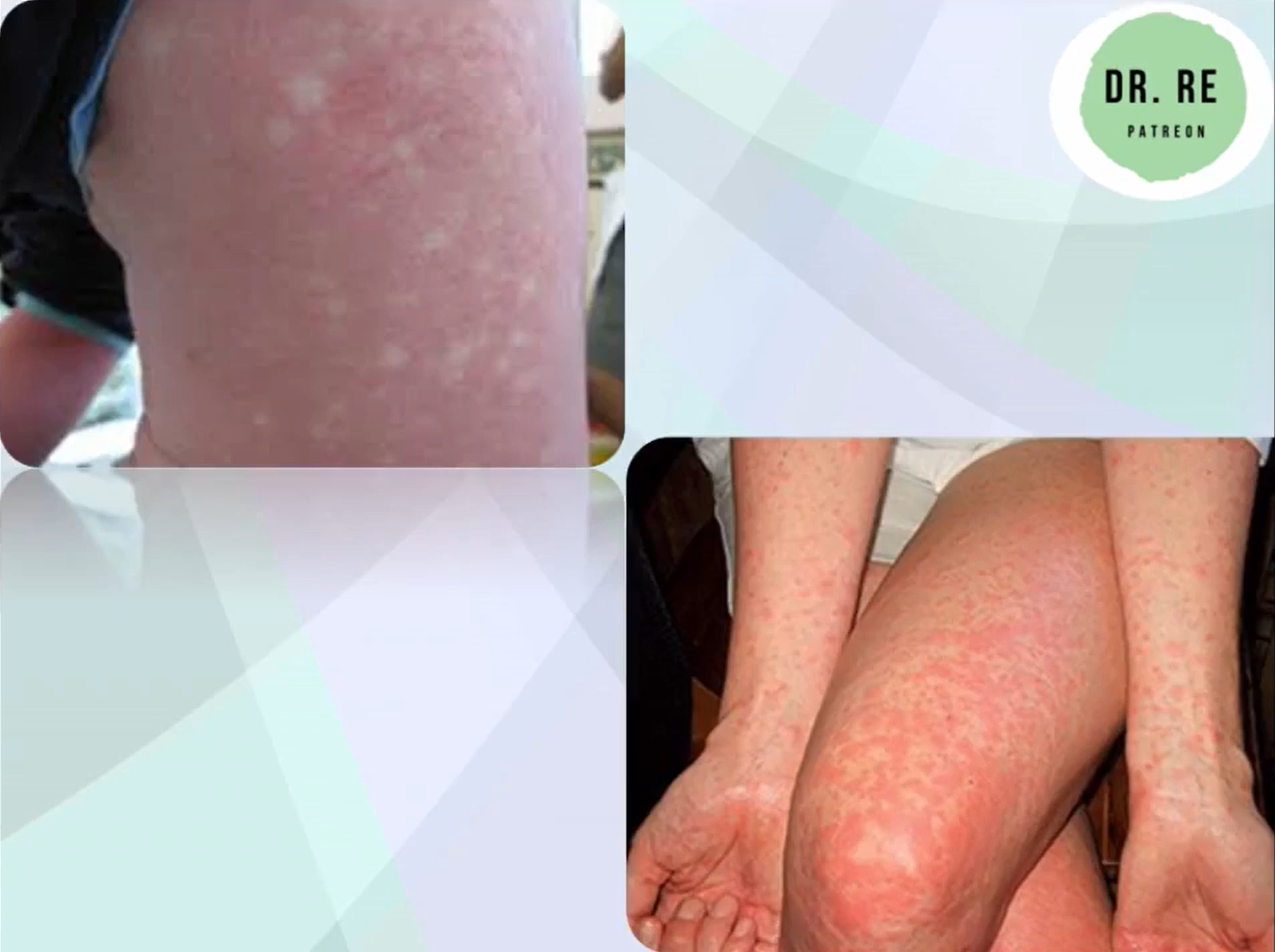 <p>¿COMO SE CARACTERIZA UN DENGUE SIN SIGNOS DE ALARMA?</p>