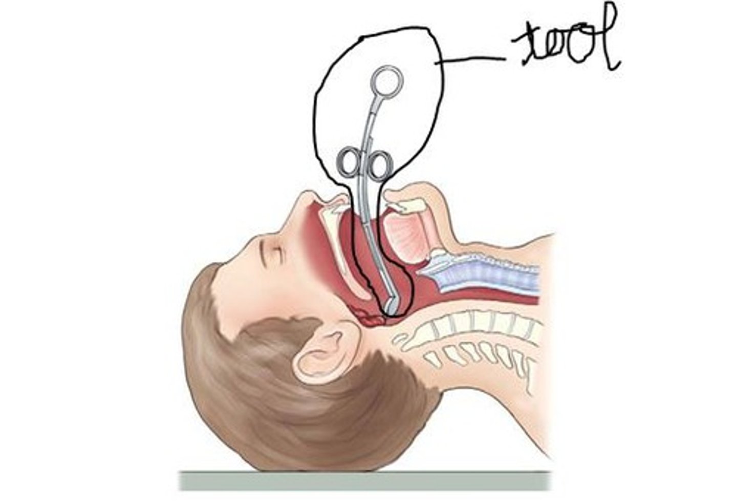 <p>instrument used to cut the adenoids</p>