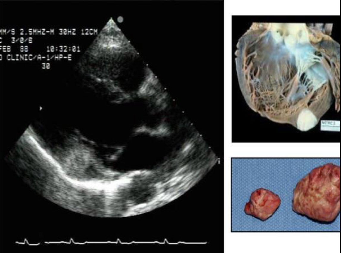 <ul><li><p>benign cardiac tumor</p></li><li><p>Bulky</p></li><li><p>Embedded in the myocardium of any chamber</p><ul><li><p>Usually ventricular</p></li></ul></li><li><p>Usually intramural</p></li><li><p>Age range: 2 - 57</p></li><li><p>Difficult to resect d/t size in symptomatic pts</p><ul><li><p>Typically results in transplant</p></li></ul></li></ul>