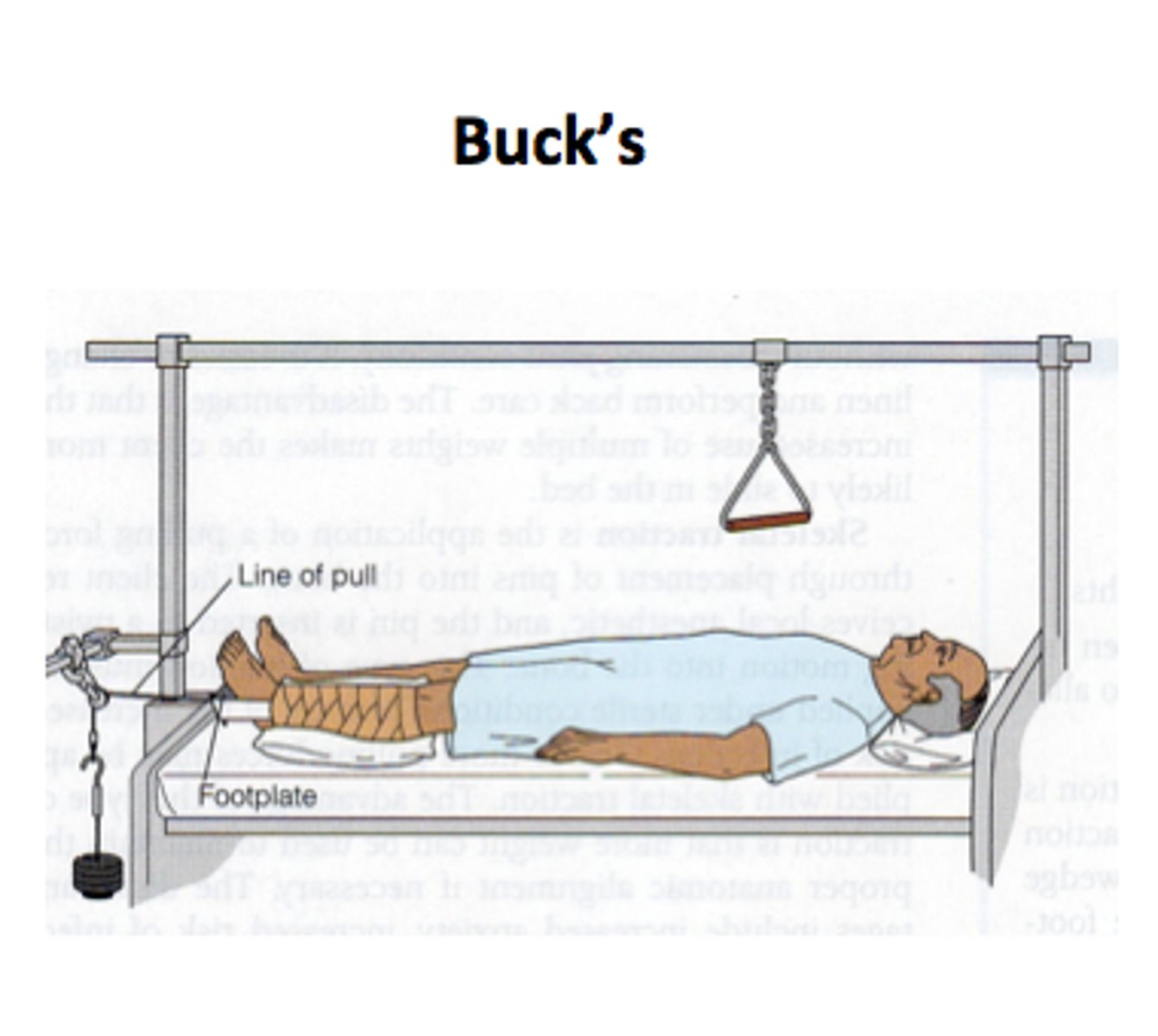 <p>▷Short term treatment</p><p>▷Tape, boots, splints</p><p>▷Maintains alignment but does not immobilize</p><p>▷Assists in reduction (possibly until surgery can be done)</p><p>▷Diminishes muscle spasms</p><p>▷Weights typically 5 or 10 lbs except pelvis</p><p>▷Example: Buck's traction</p>