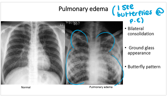 <p>pulmonary edema:</p><ol><li><p>bilateral consolidation</p></li><li><p>butterfly pattern</p></li></ol><p></p>
