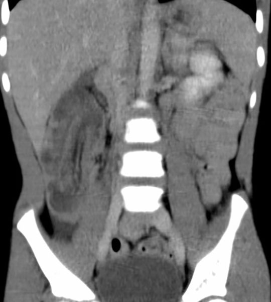 <p>What is transient intussusception?</p>