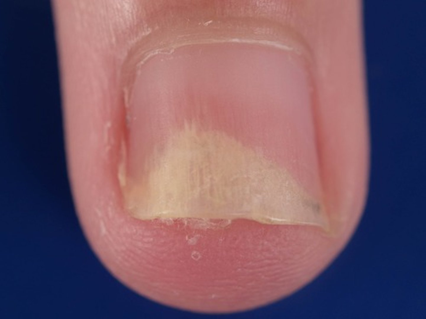 <p>= loslating van de nagelplaat</p>