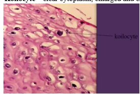 <p><span style="background-color: transparent; font-family: &quot;Times New Roman&quot;, serif;">*<strong>Koilocyte</strong> – clear cytoplasm, enlarged and crinkled nucleus</span></p>