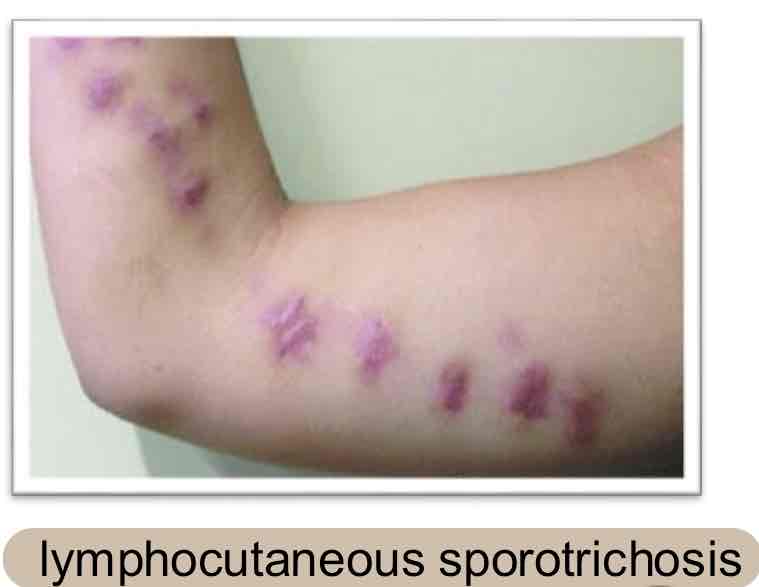 <p>Horses/mules &amp; via skin wounds → lymphatic spread</p>