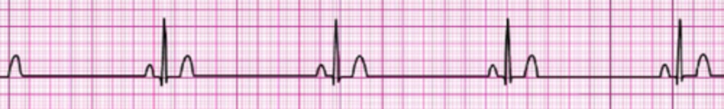 <p>Sinus Bradycardia</p>
