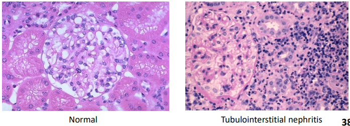 <p>etiology of Tubulointerstitial Nephritis</p>