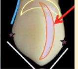 <p><mark data-color="green" style="background-color: green; color: inherit">maxillary canines #6 and #11; distal contact</mark></p>