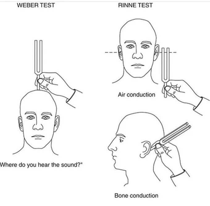 <p>Involves using a time & a tuning fork to determine the difference between conductive & sensorineural hearing loss.</p>