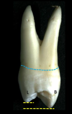 <p>distal</p>