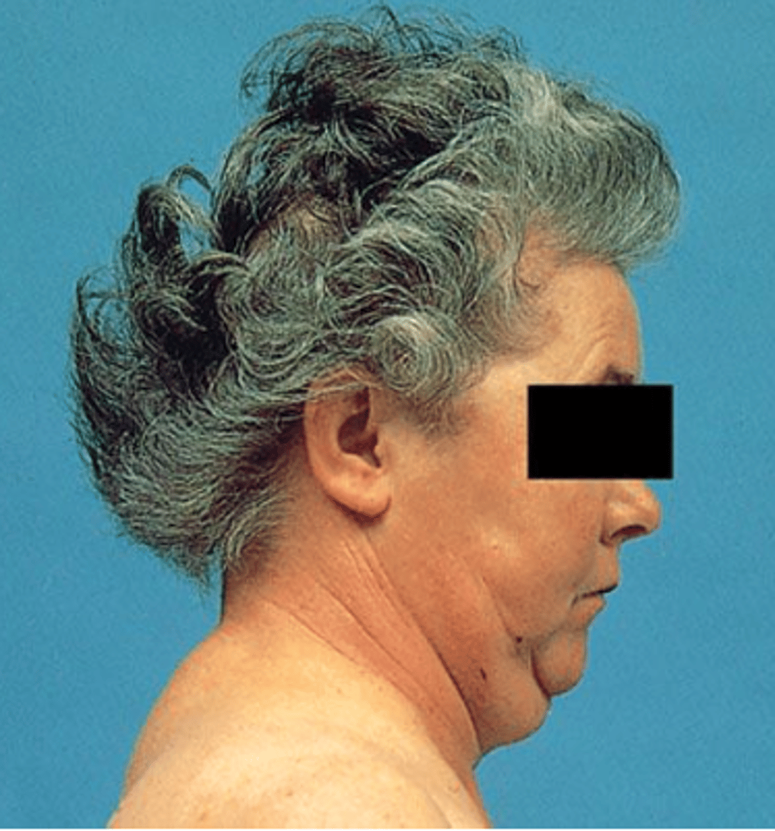 <p>excessive production of acth will stimulate excess cortisol; edema with central trunk and cervical obesity, moon face, muscle weakness, thin arms and legs, reduced height, purple abdominal striae, bruising, acne</p>