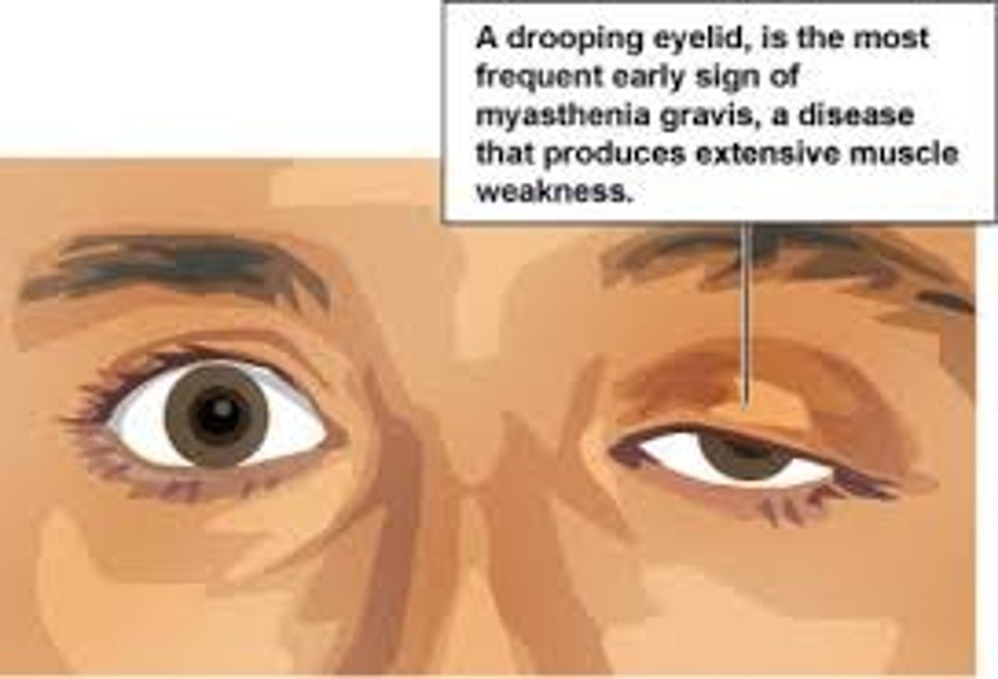 <p>autoimmune neuromuscular disorder characterized by weakness of voluntary muscles - the body produces antibodies against the neurotransmitter acetylcholine, which is a neurotransmitter responsible for motor movement</p><p>this disease disrupts neural transmission of acetylcholine </p>