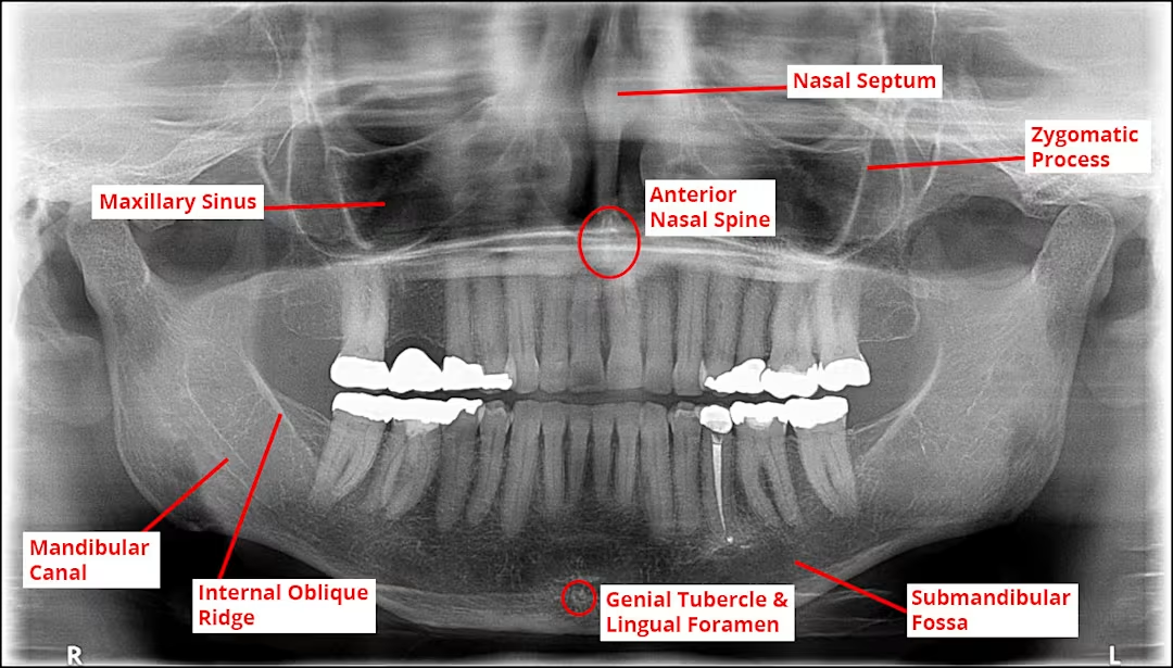 <ol><li><p>Incisive foramen</p></li><li><p>Superior foramina of the incisive canal</p></li><li><p>Medial palatal suture</p></li><li><p>Lateral (canine) fossa </p></li><li><p>nasal cavity</p></li><li><p>nasal septum</p></li><li><p>floor of the nasal cavity</p></li><li><p>anterior nasal spine</p></li><li><p>inferior nasal conchae</p></li><li><p>maxillary sinus - septa</p></li><li><p>maxillary sinus - nutrient canals</p></li><li><p>inverted Y</p></li><li><p>maxillary tuberosity</p></li><li><p>Hamulus</p></li><li><p>Zygomatic process of the maxilla</p></li><li><p>Zygoma</p></li></ol><p></p>