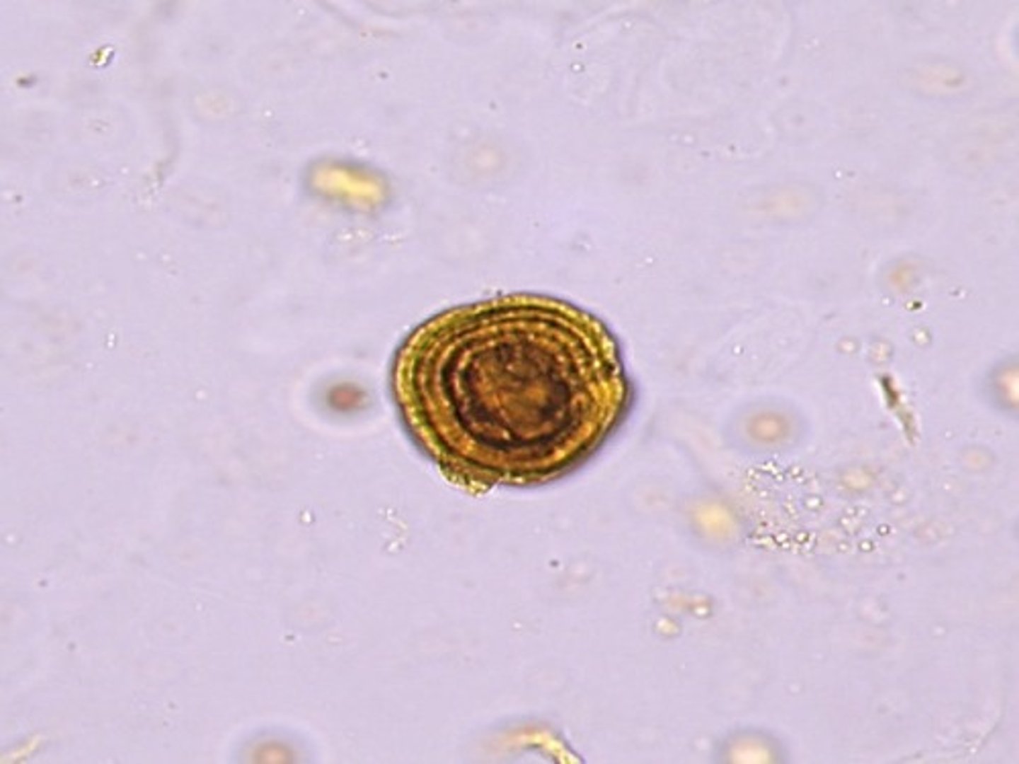 <p>-Abnormal= when present should be accompanied by tyrosine crystals</p><p>-pH= Acid/neutral</p><p>-color/form= yellow (concentric circles)</p><p>-disorders= Liver disease</p>