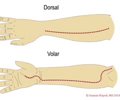 <p><span>Pertaining to the palm or the sole. For example, the volar surface of the forearm is the portion of the forearm that is on the same side as the palm of the hand.</span></p>
